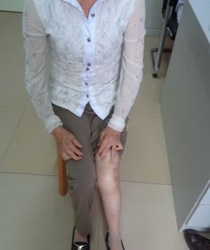 刘阿姨经过治疗后,刘阿姨膝部关节正常,已恢复常人 刘阿姨经过治疗后,刘阿姨膝部关节正常,已恢复常人